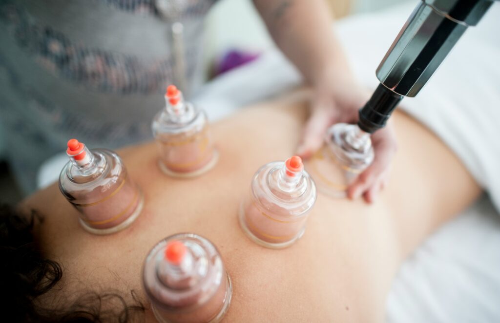 cupping-1024x663.jpg